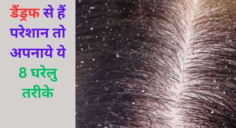 dandruff kaise hataye